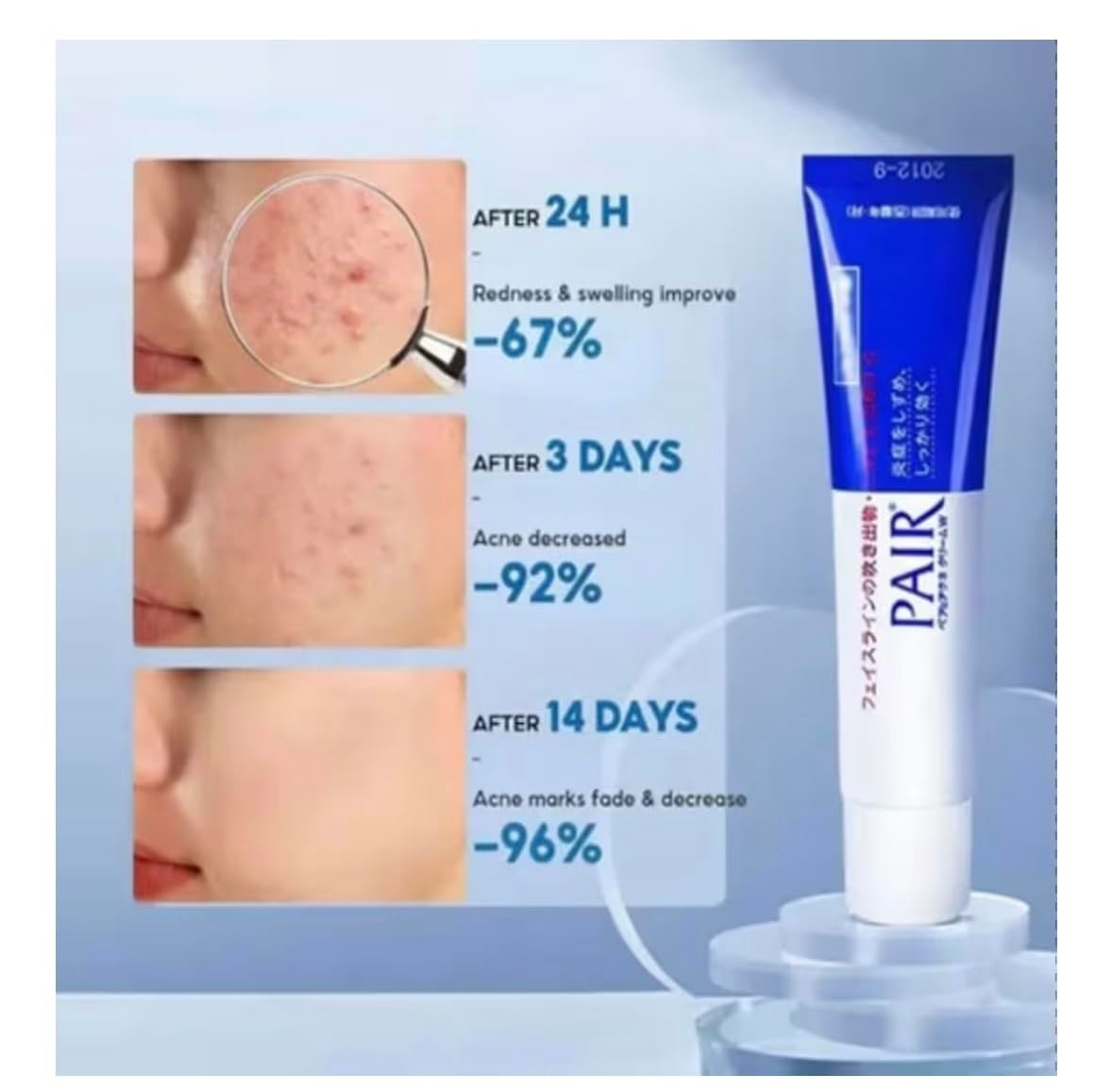 PAIR Acne Treatment Cream , Japanese Medicated Skincare 14g, Japan Lion acne cream - Image 5