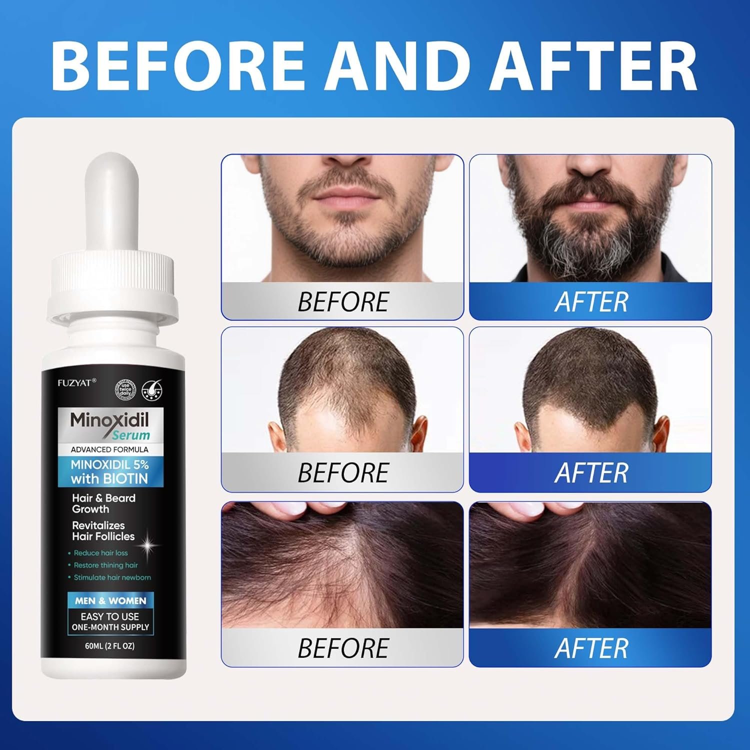 5% Minoxidil for Men, Minoxidil for Women Hair Growth Treatment, Beard Growth Serum, Biotin & Castor Oil Enriched,Strengthens Weak Roots, Repairs Thinning Hair (120ml) - Image 4