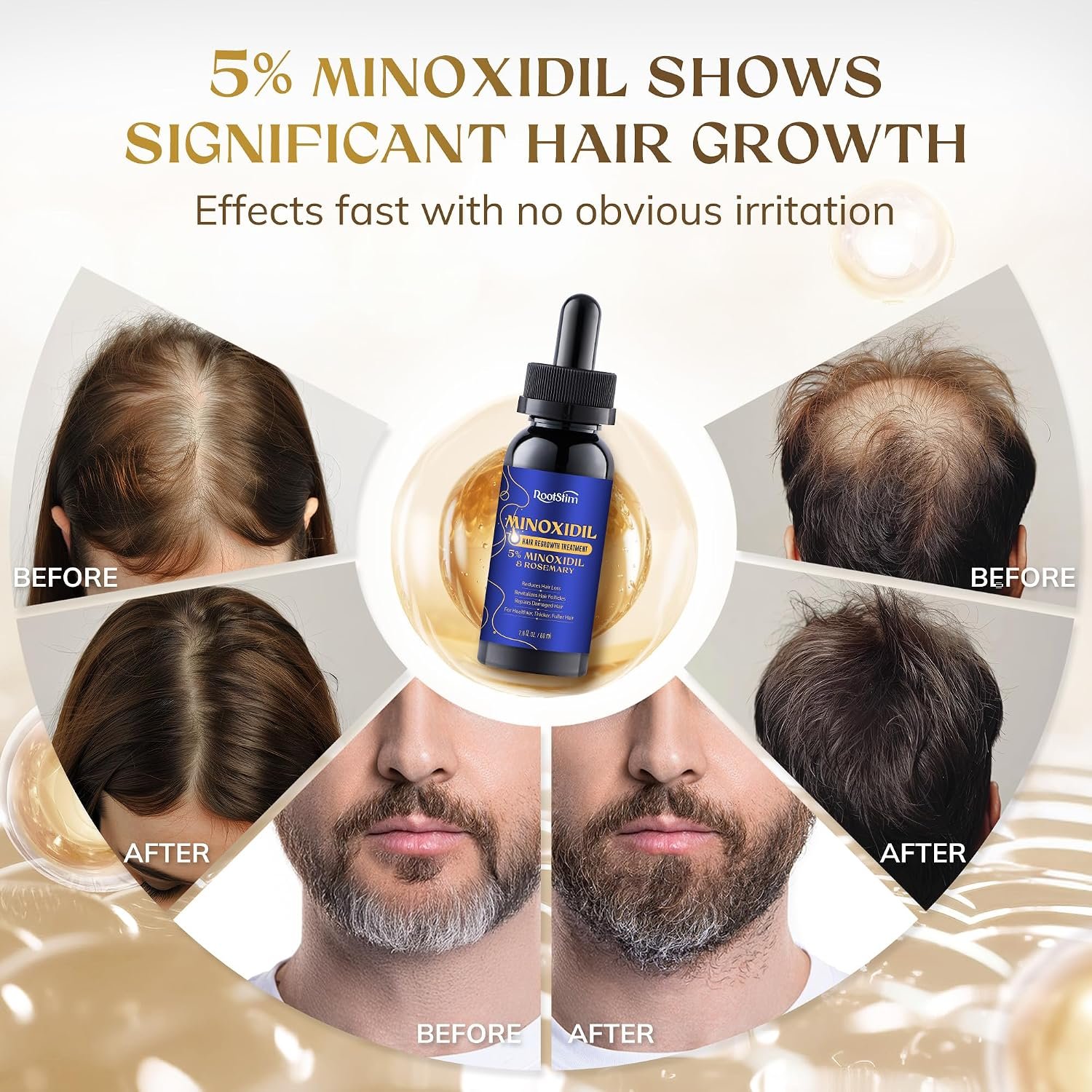 5% Minoxidil Hair Growth Serum for Men Women, with Rosemary &Biotin, Hair Loss Treatment Extract Support Thicker Fuller Healthier Hair Texture - 2 Fl Oz - Image 2